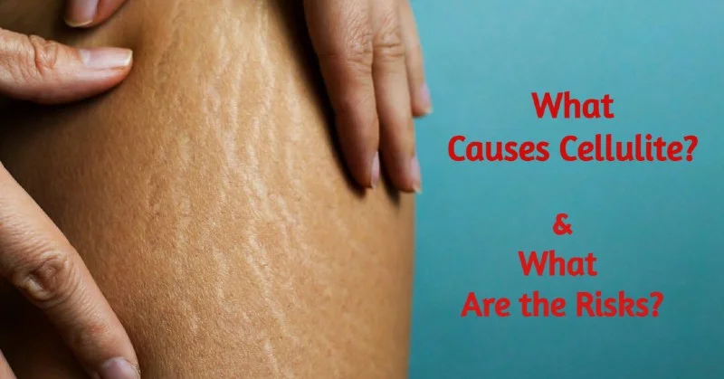 What to Do About Cellulite
