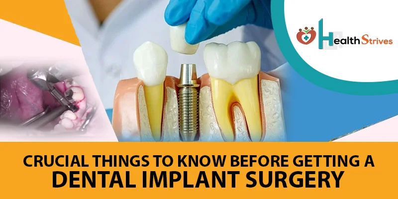 CRUCIAL THINGS TO KNOW BEFORE GETTING A DENTAL IMPLANT SURGERY