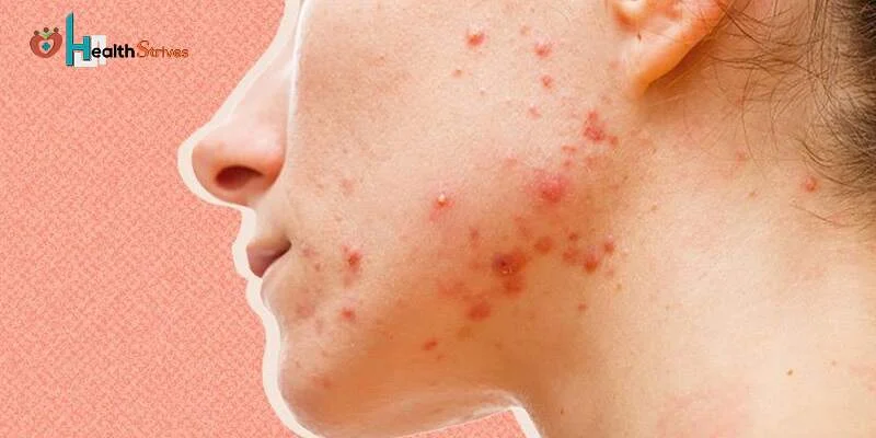 Acne Problems: Reasons, Treatments, and More 