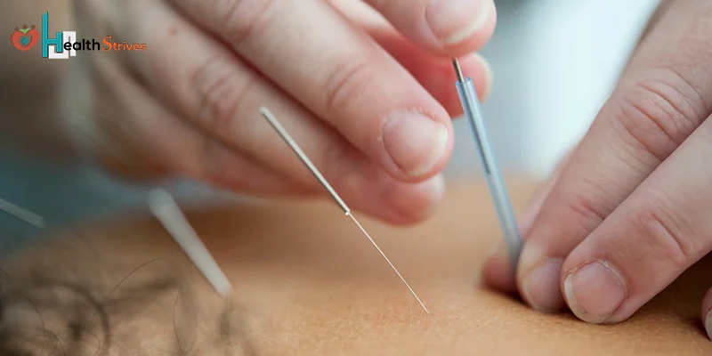 Ten Things to Know About Acupuncture